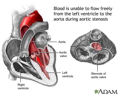 Diagram explanation of how Aortic Stenosis effects the heart.