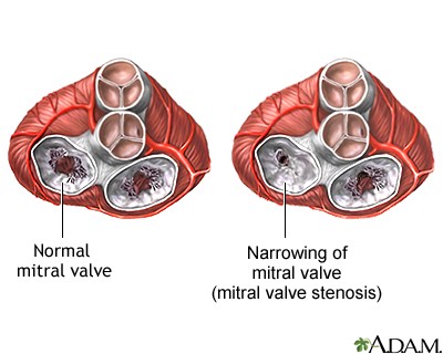 the difference between a normal mitral valve and a valve with mitral valve stenosis