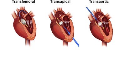 three approaches of tavr.
