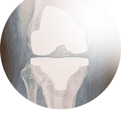 Joint implant illustration.