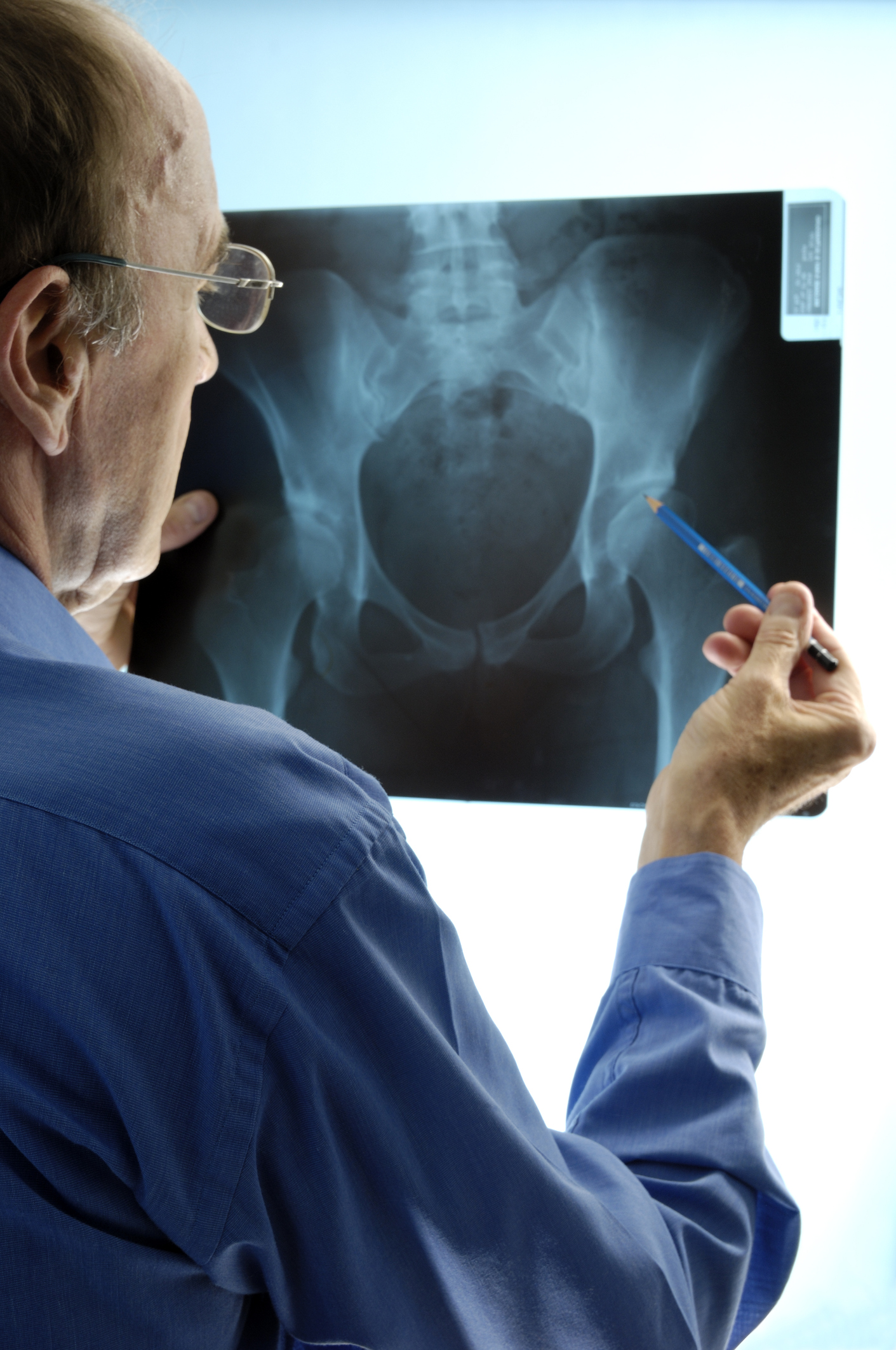 Hip arthroplasty