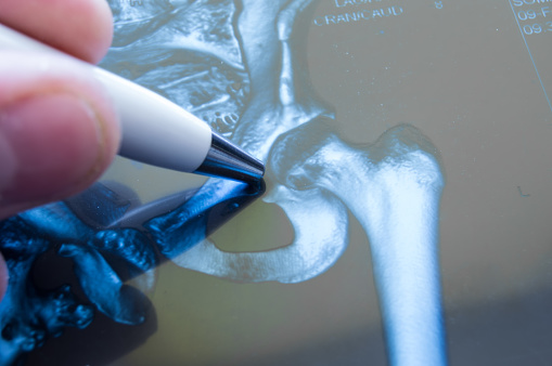 Joint Replacement