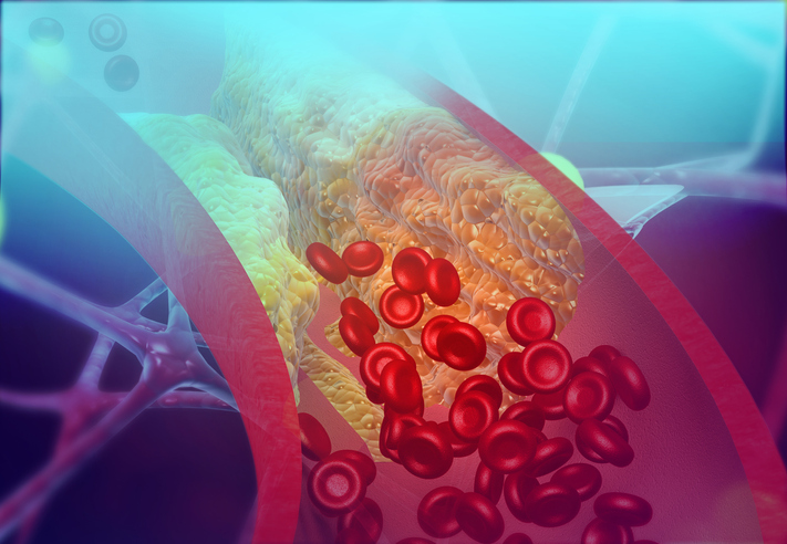 Cholesterol buildup in arteries 