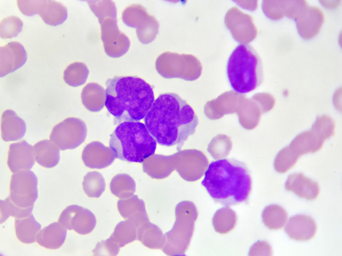 AML cell image