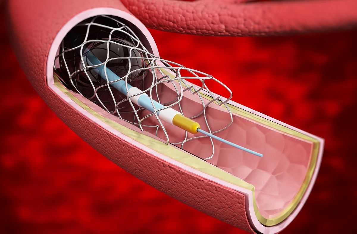 Rendering of a stroke stent endovascular mechanical thrombectomy