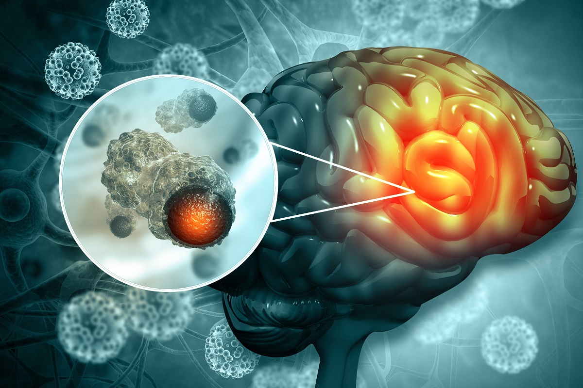 stock illustration of brain with area lit up and inset illustration of central nervous system tumor image