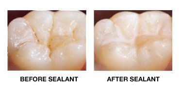 tooth before and after sealant application image