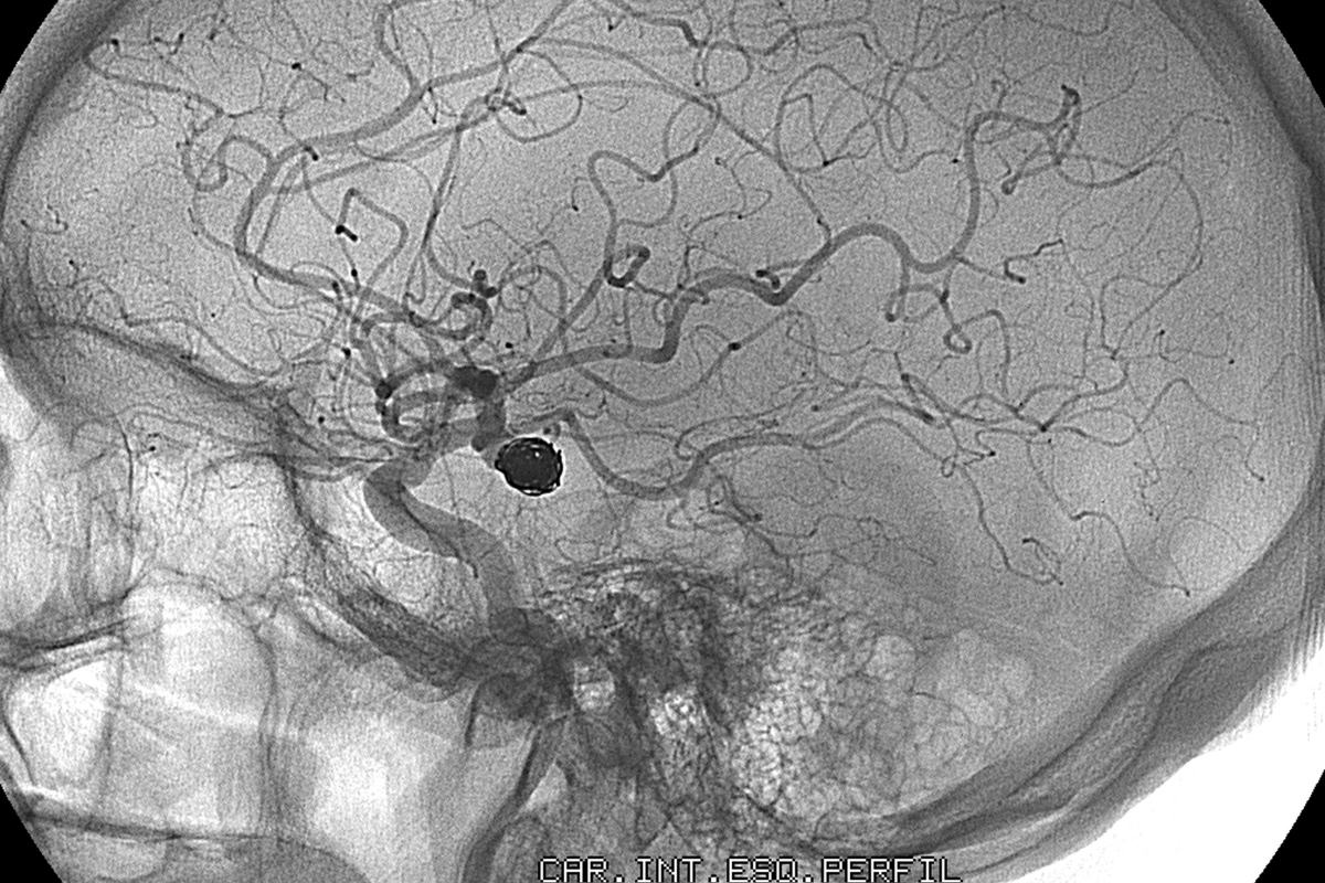 Aneurysm in the brain