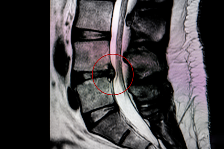 Herniated Disc